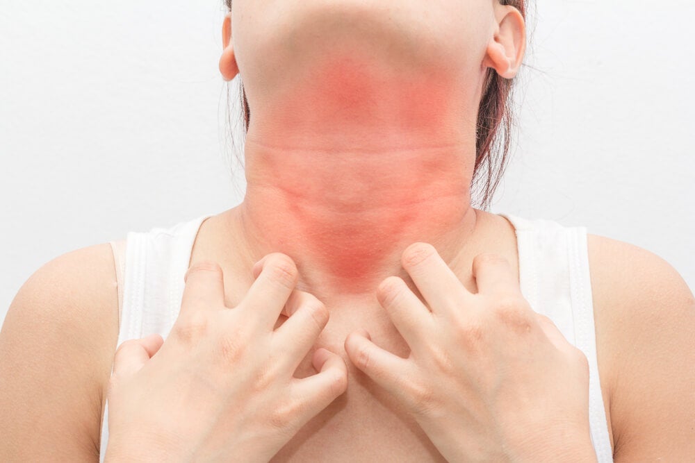 alergia al pistacho ejemplo 2