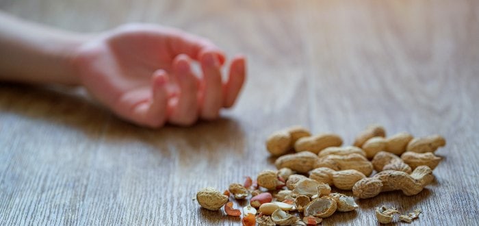 que hacer en caso de alergia al mani ejemplo